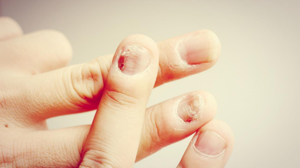 How to Treat Thumb Nail Infection at Home Step by Step and Tips!