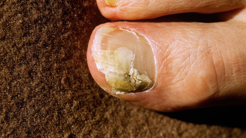 How to Treat Nail Fungus Naturally: A Complete Guide!