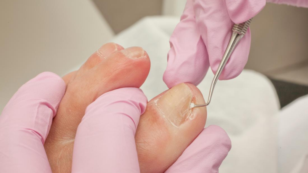 How to Treat Infected Toenail at Home: A Complete Guide!