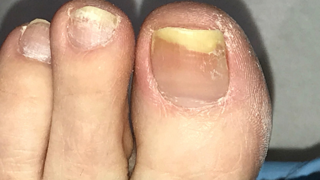 How to Treat Infected Nail at Home Step by Step and Tips!