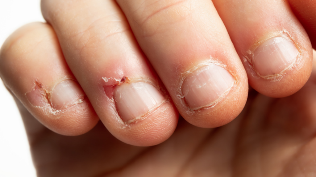 How to Stop Allergic Reaction to Gel Nails at Home!