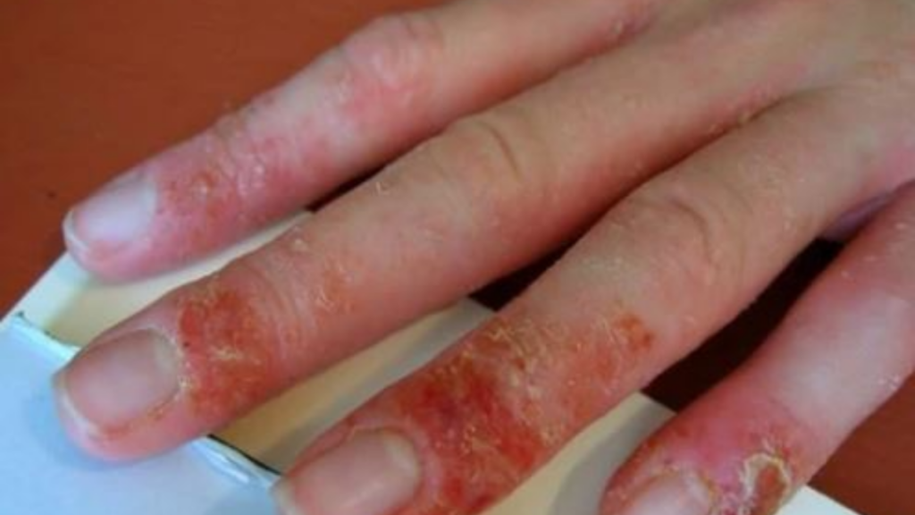 How to Stop Allergic Reaction to Gel Nails at Home!