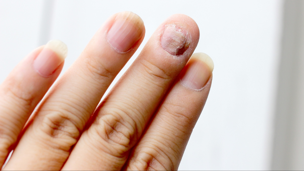 How to Remove Nail Fungus Fast Without Harm to Your Real Ones!