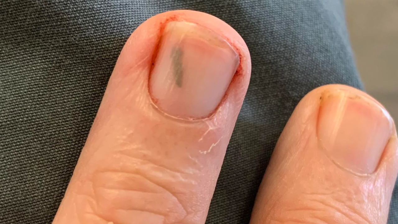 How to Remove a Splinter from Under Your Nail!