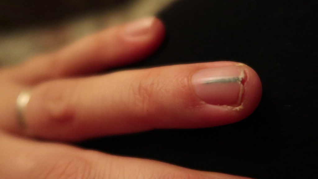 How to Remove a Splinter from Under Your Nail!
